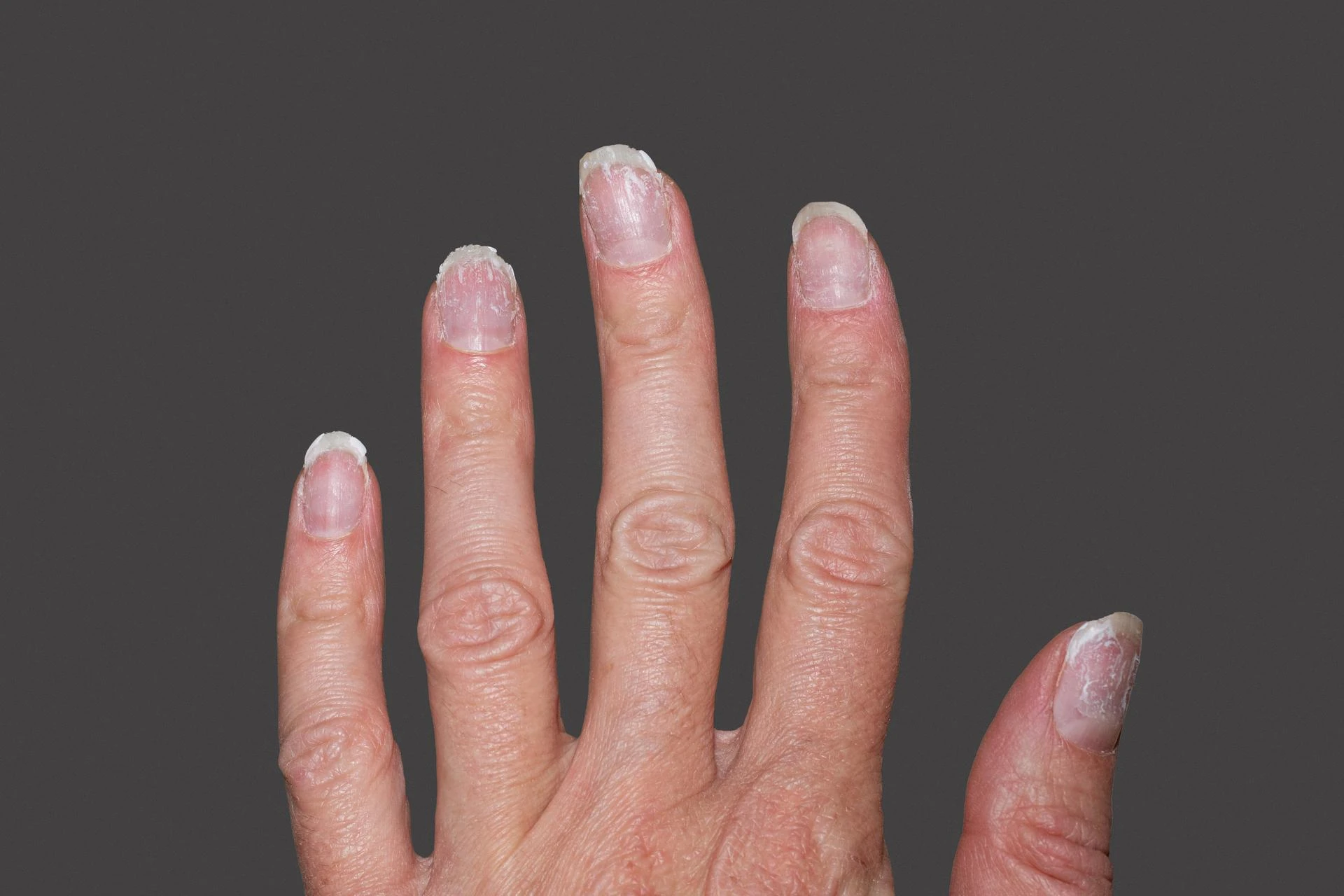 Nail Psoriasis